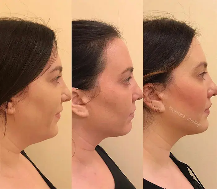 2” Kybella treatments under the chin and along the jawline (1)