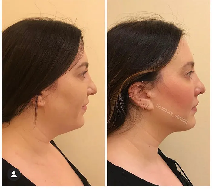 2” Kybella treatments under the chin and along the jawline (2)