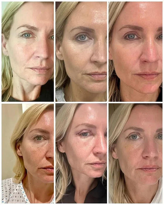 2 week blepharoplasty before and after​ women
