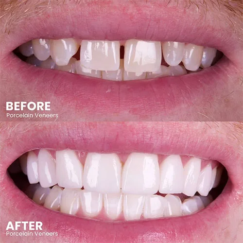 4 veneers on front teeth before and after (1)