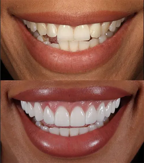 4 veneers on front teeth before and after (2)