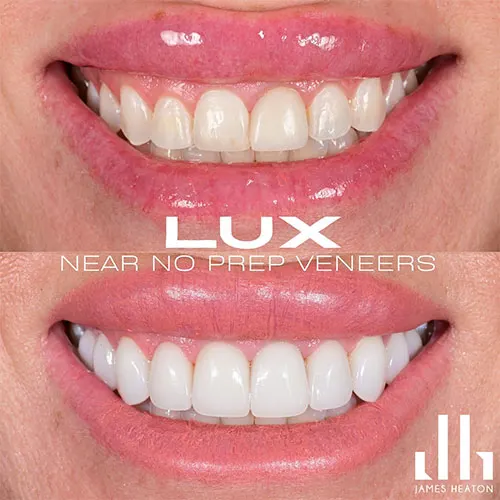 4 veneers on front teeth before and after (3)