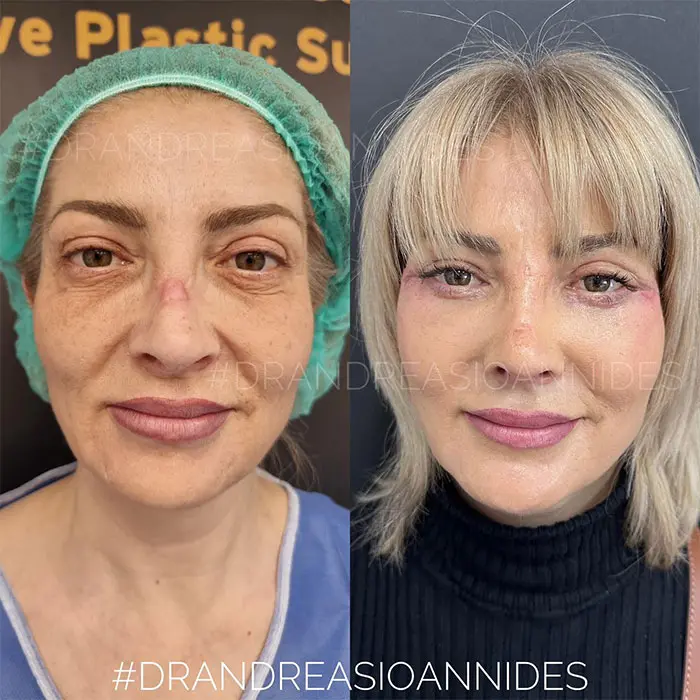 After 15 days of Blepharoplasty Before and After​
