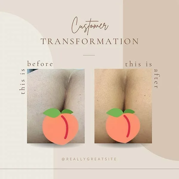 Anal Bleaching Before and After​ photos