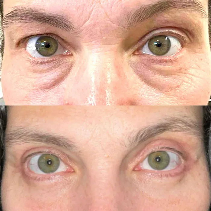 Before & After Upper + Lower Eyelid Blepharoplasty