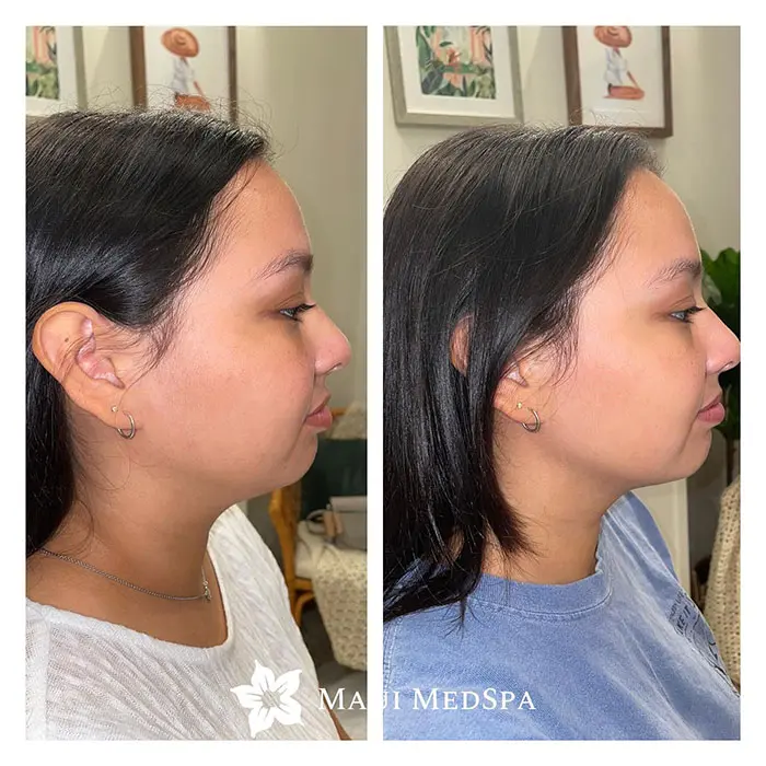 Before and after of just one treatment of Kybella