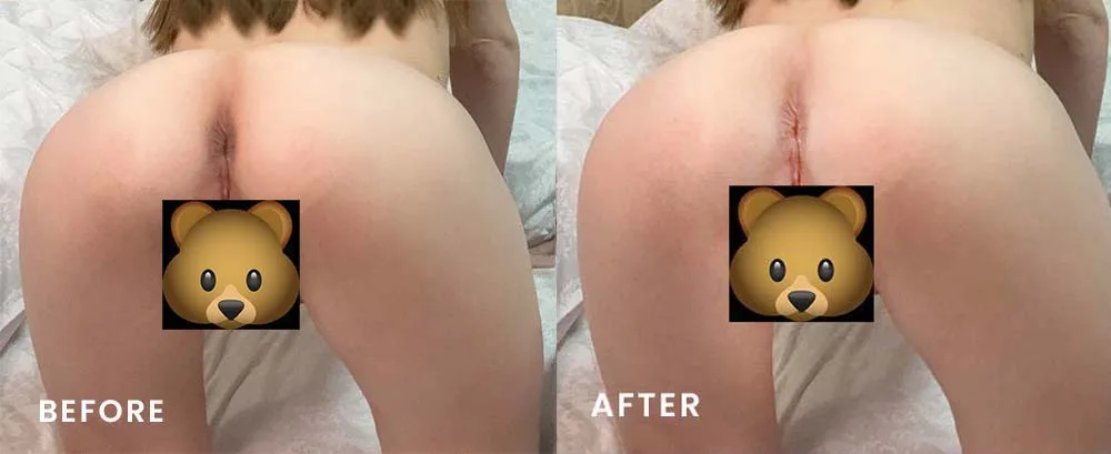Bleaching anus before and after photos