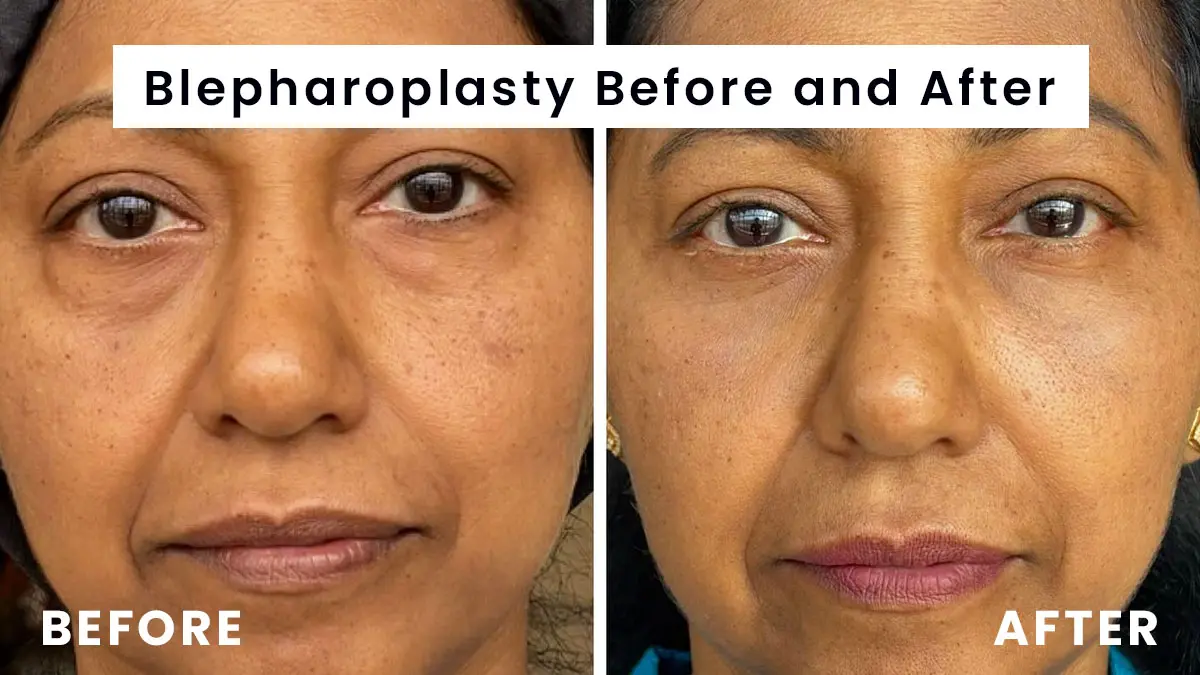 Blepharoplasty Before and After​ Photos day by day