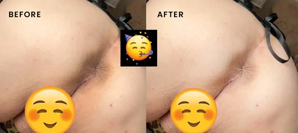 Intimate bleaching results pictures