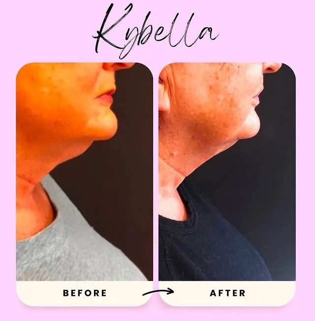 Kybella before and after 1 treatmen chin old age