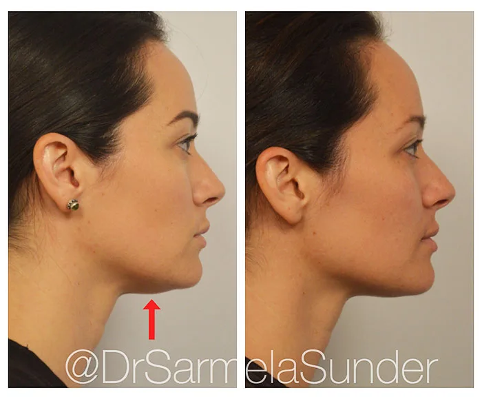 Kybella before and after 1 treatment (1)
