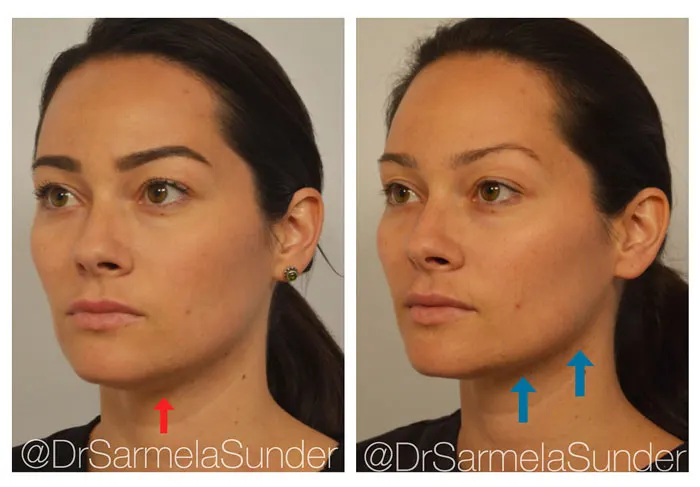 Kybella before and after 1 treatment (2)