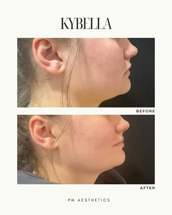 Kybella before and after 1 treatment (3)