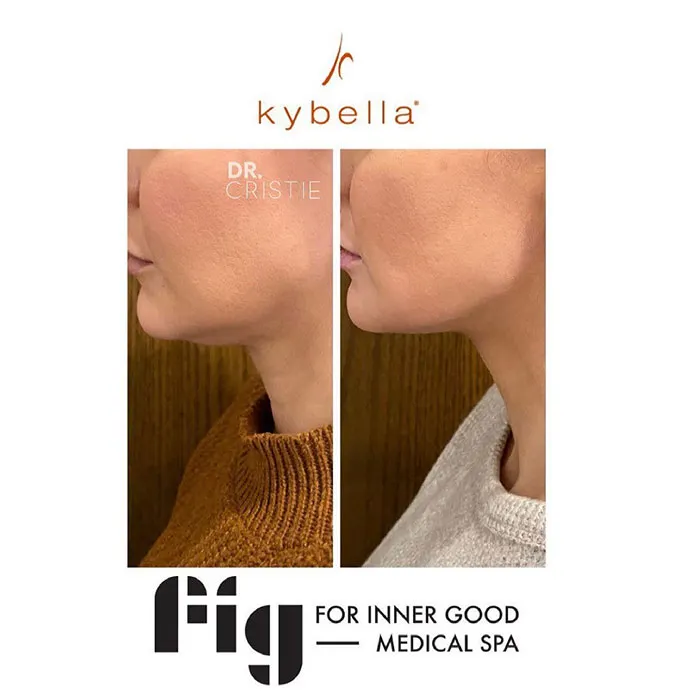 Kybella before and after 1 treatment (4)