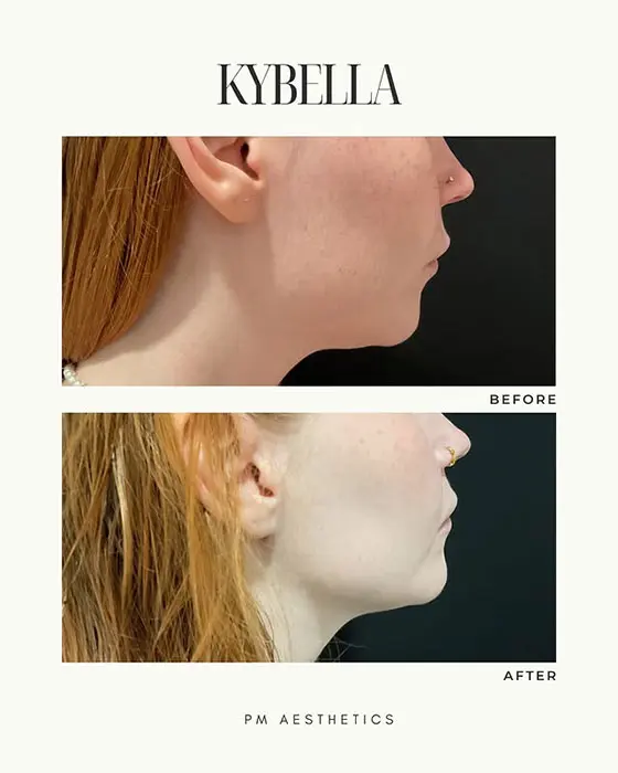 Kybella before and after 1 treatment (6)
