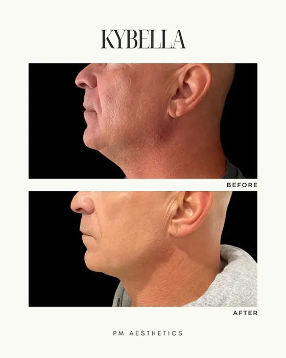 Kybella before and after 1 treatment (7)