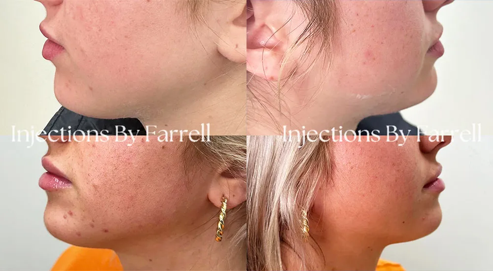 Kybella before and after 1 treatment (8)