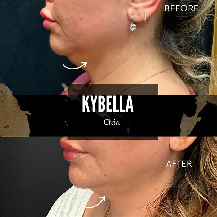 Kybella before and after 1 treatment chin photos