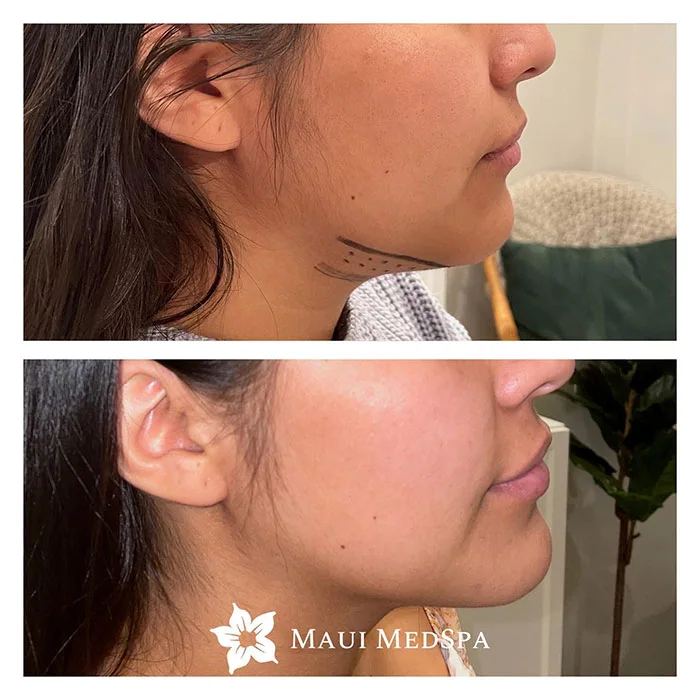 Kybella before and after 1 treatment chin
