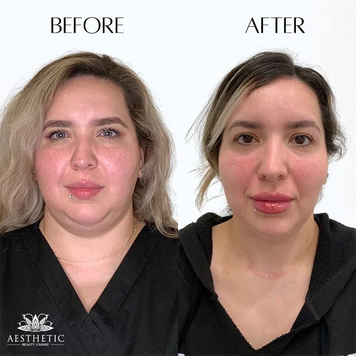 Kybella before and after 1 treatment face