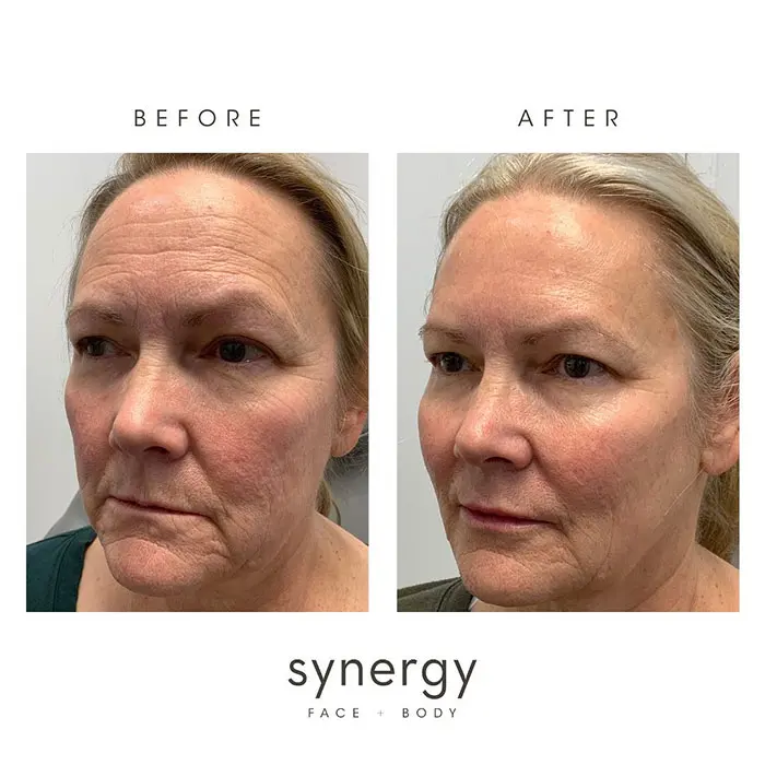 Kybella before and after 1 treatment full face