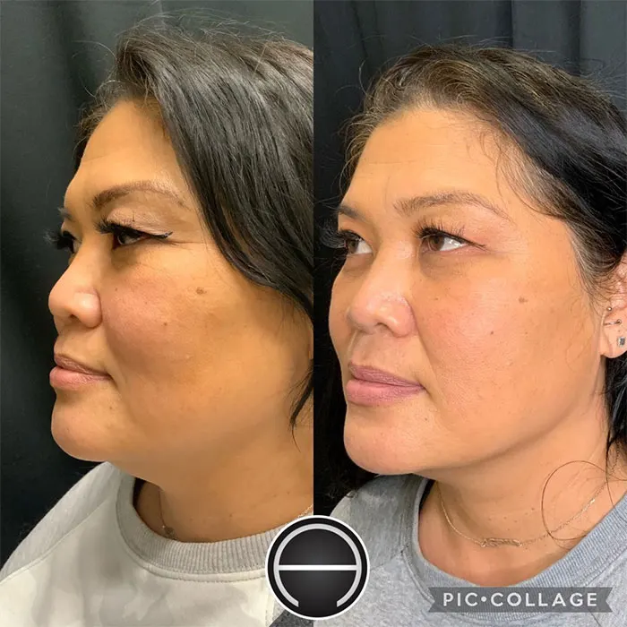 Kybella before and after 1 treatment