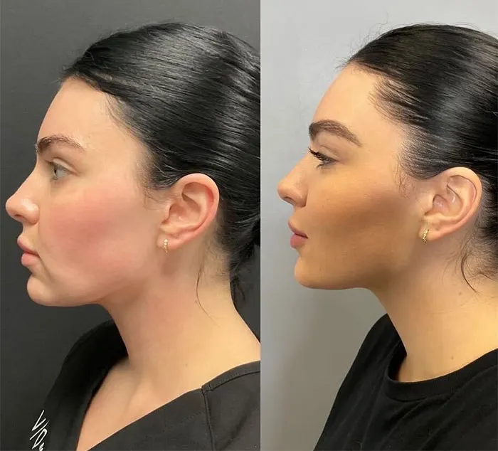 Kybella before and after (1)
