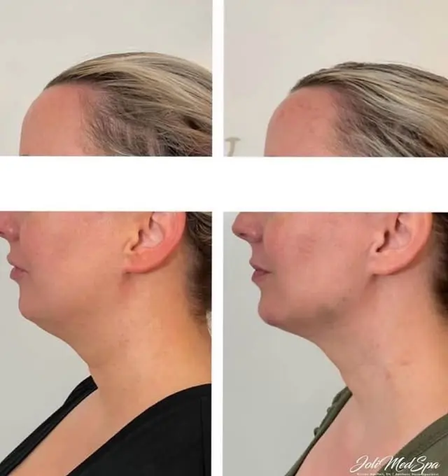 Kybella before and after 2 treatment (1)