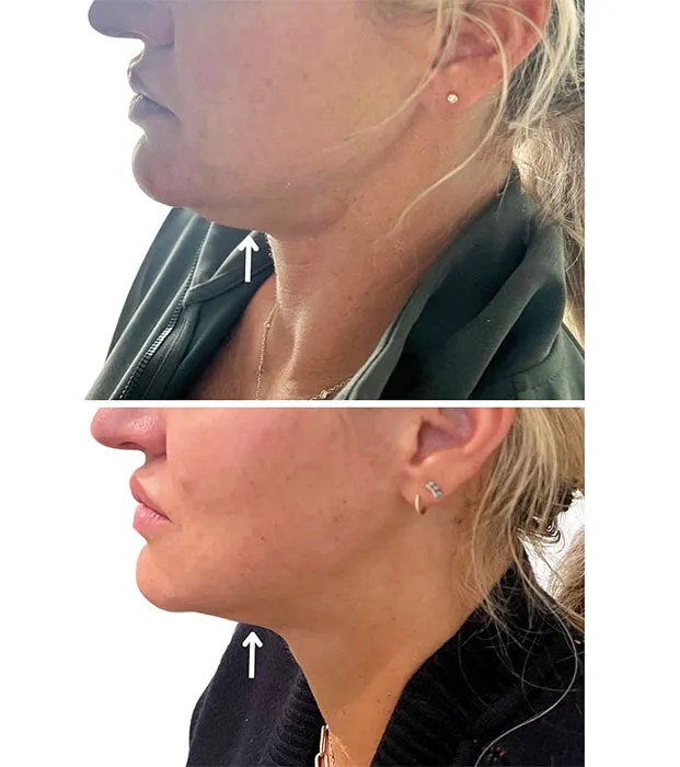 Kybella before and after 2 treatment (2)