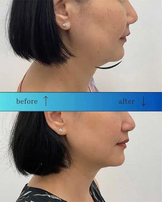 Kybella before and after 2 treatment (3)