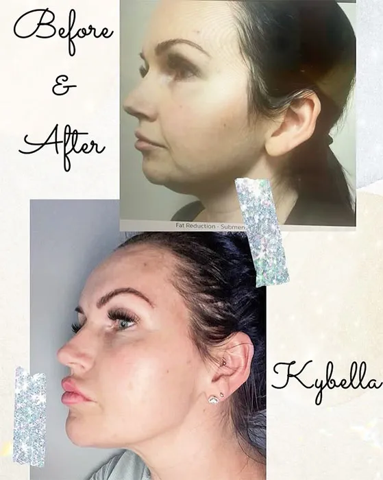 Kybella before and after 2 treatment (4)