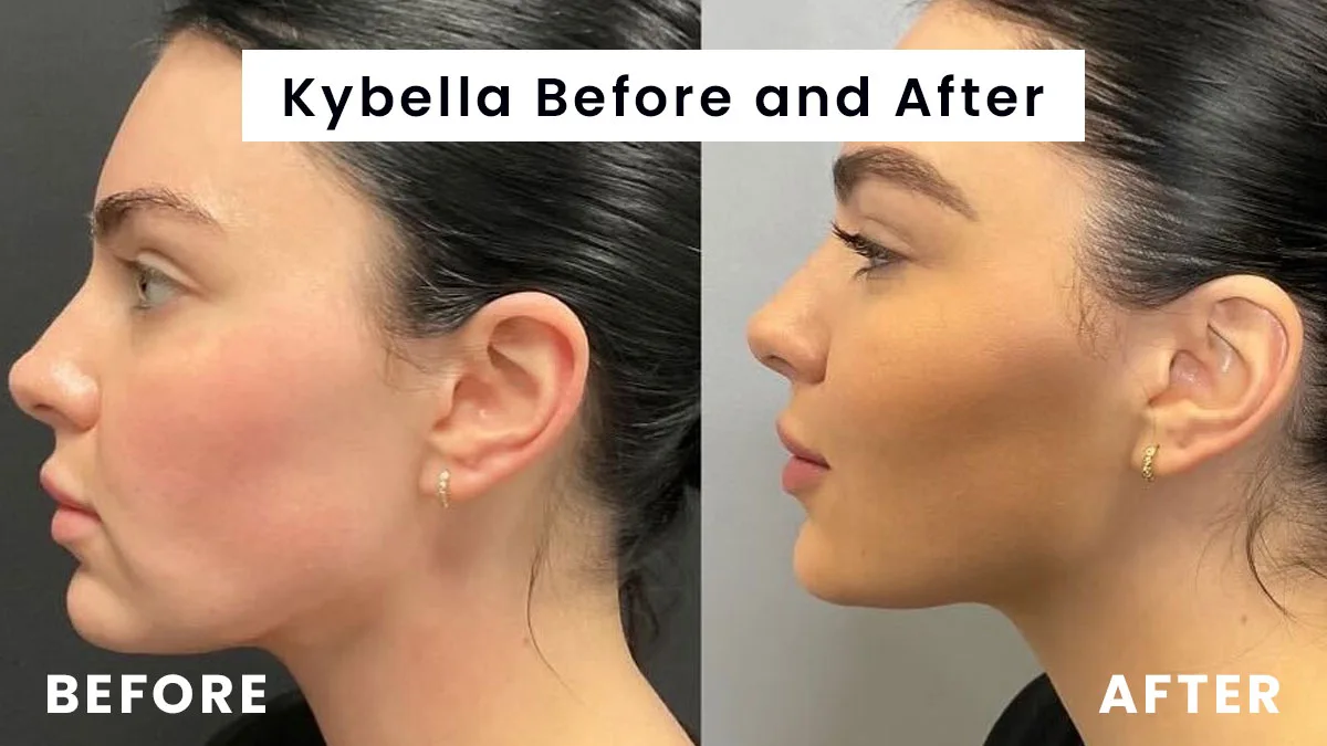 Kybella before and after (2)