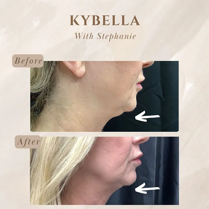 Kybella before and after 3 treatment (1)