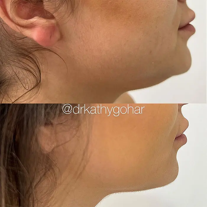 Kybella before and after 3 treatment (2)