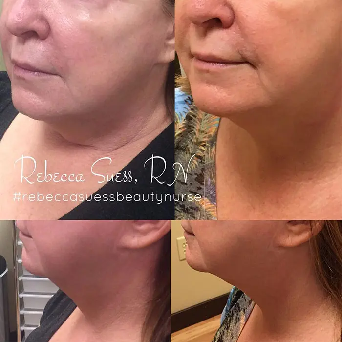 Kybella before and after 3 treatment (3)