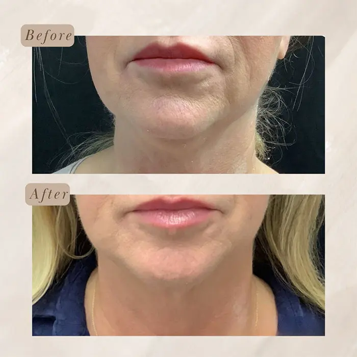 Kybella before and after 3 treatment (4)