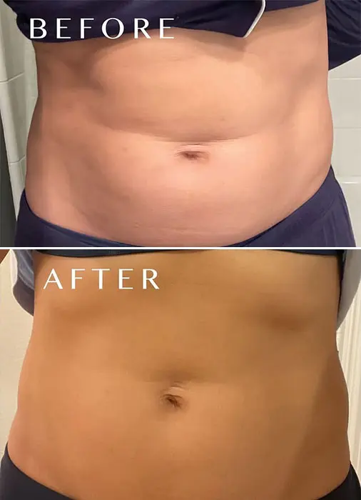 Kybella before and after belly