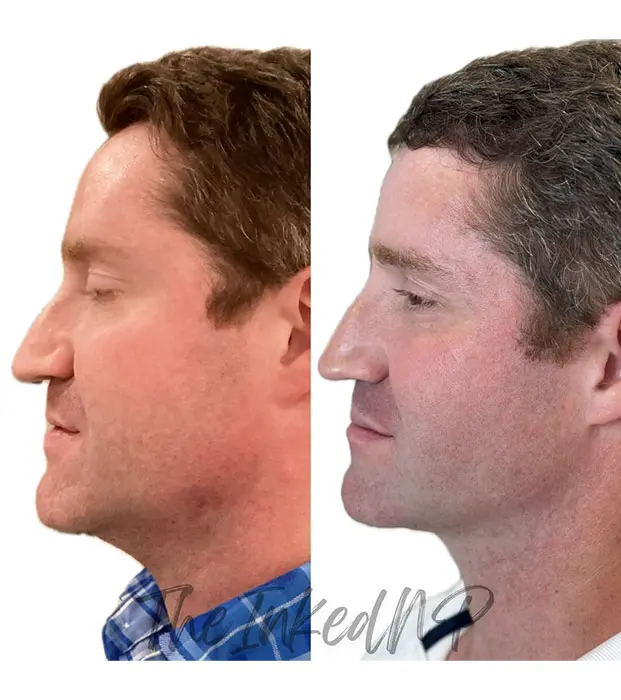 Kybella before and after jowls men