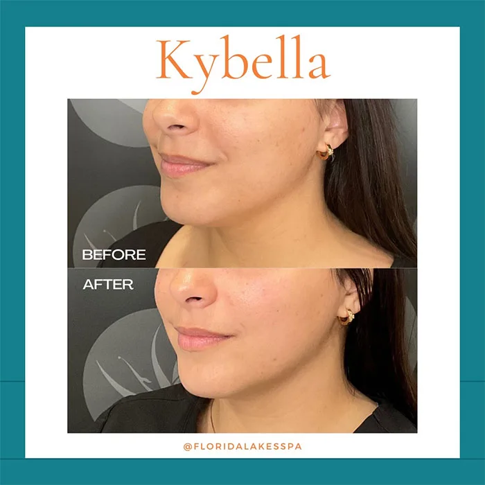 Kybella before and after picture (4)