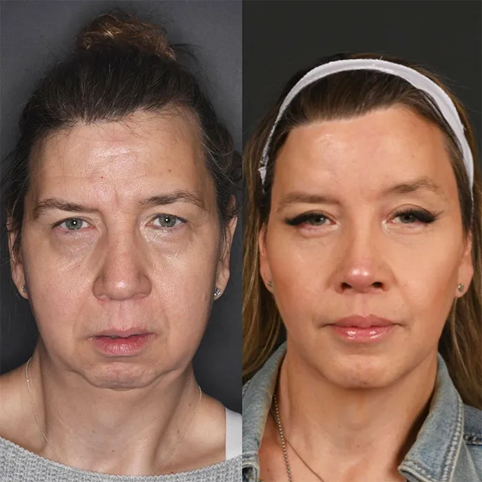 One-year Full Facial Transformation Blepharoplasty (1)