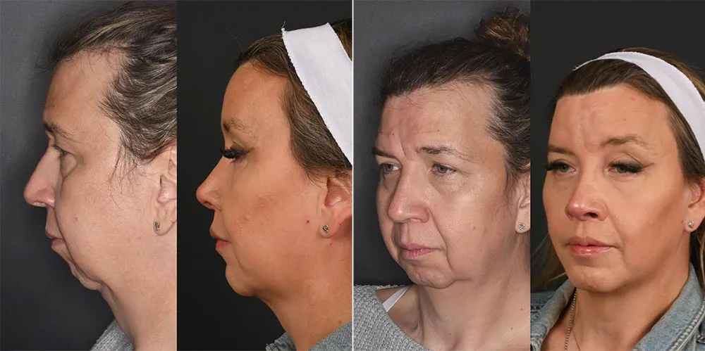 One-year Full Facial Transformation Blepharoplasty (2)