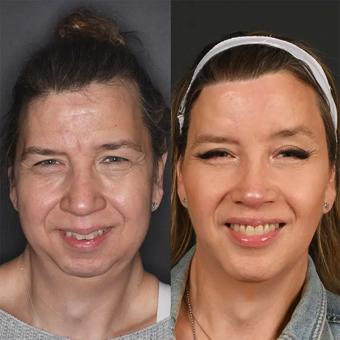 One-year Full Facial Transformation Blepharoplasty (1)