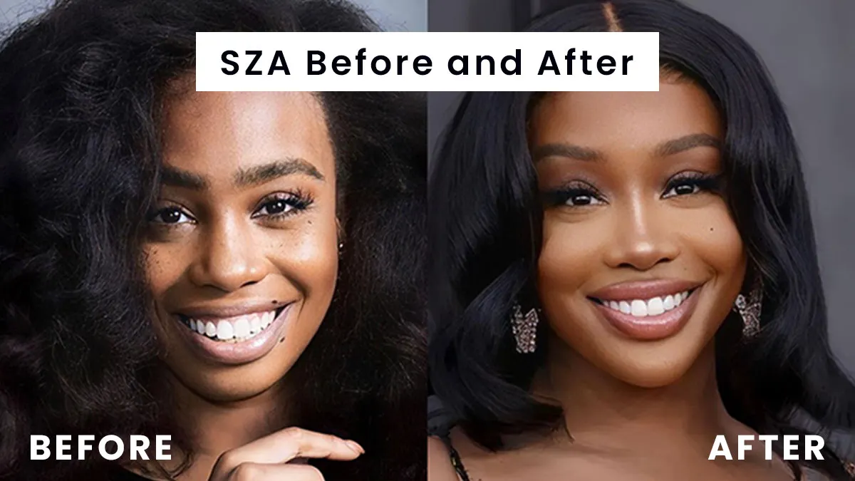 SZA Before and After BBL, Plastic Surgery & Face Transformation