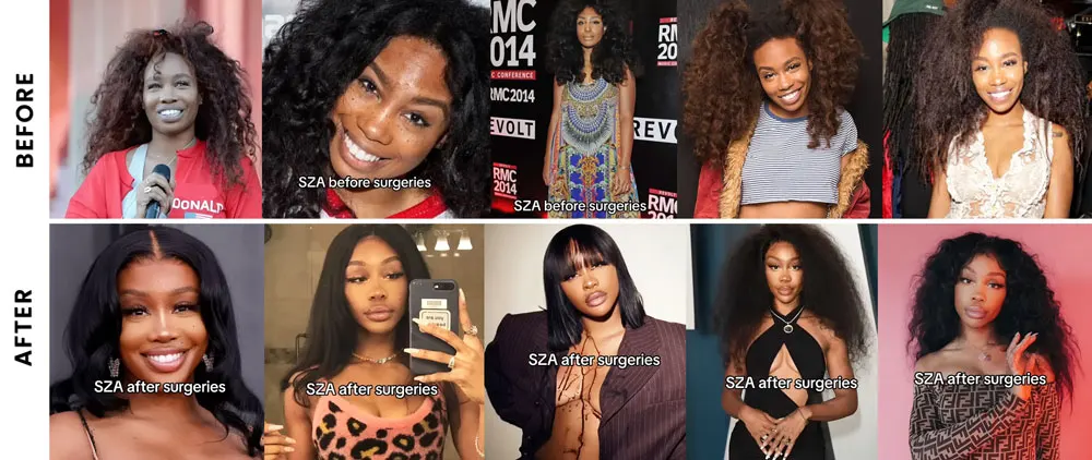 SZA before and after bbl plastic surgery face & body transformation
