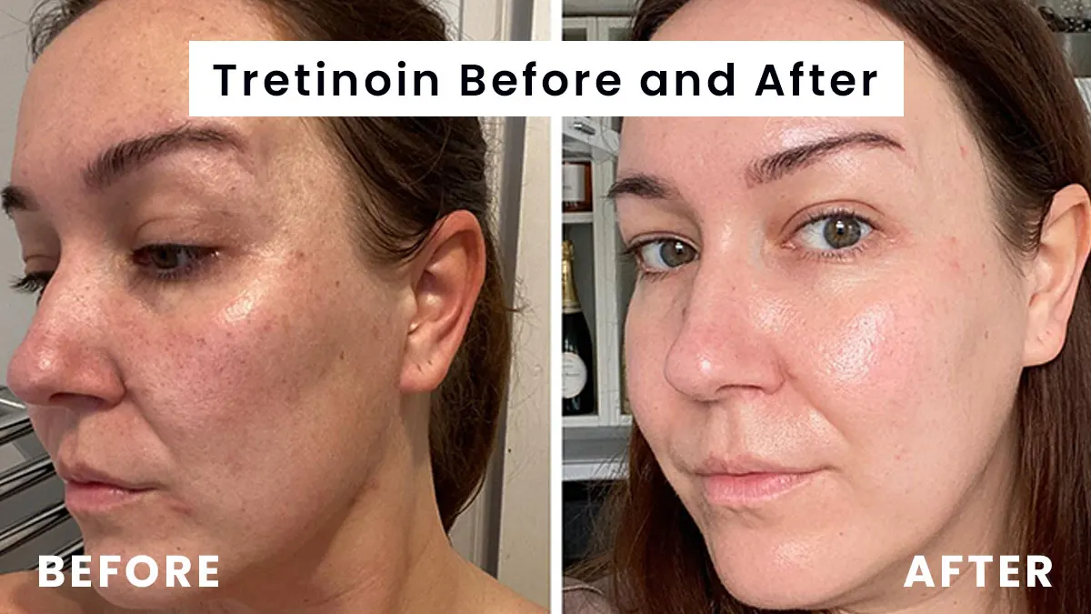 Tretinoin before and after pictures (2)