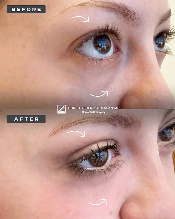 Upper & Lower Blepharoplasty Before and After Photos (1)