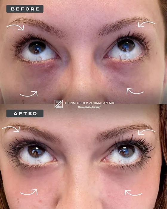 Upper & Lower Blepharoplasty Before and After Photos (2)