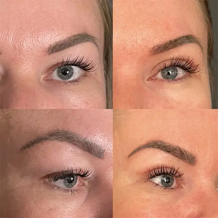 Upper & Lower Blepharoplasty Before and After Photos (3)