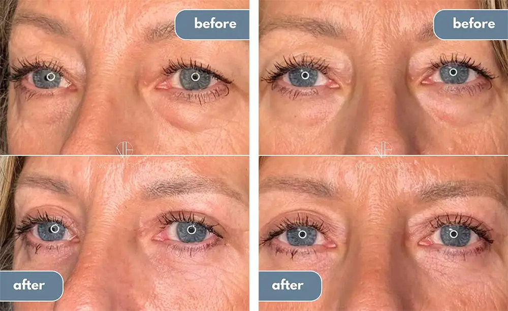 Upper and lower blepharoplasty 2 Months results
