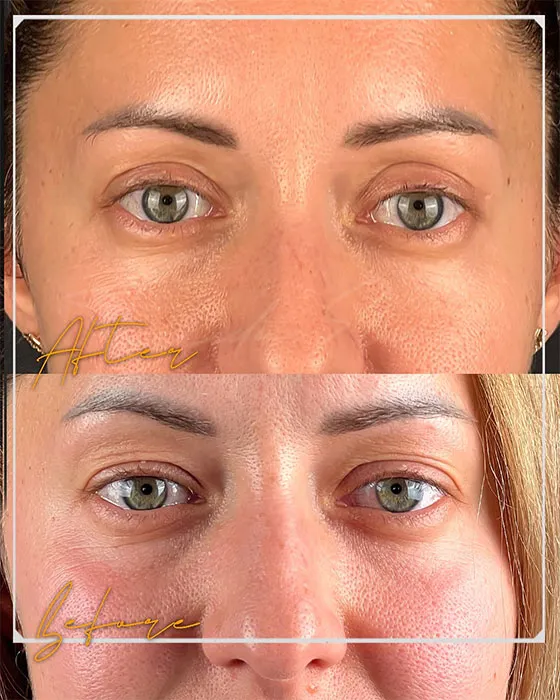before and after blepharoplasty pictures (2)